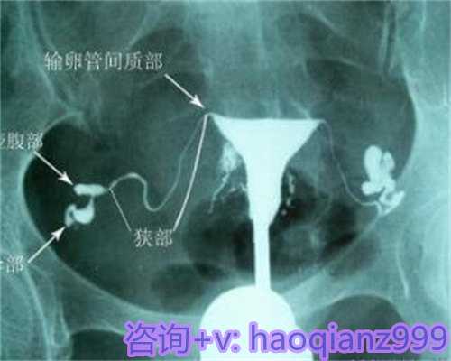 广西合法代孕专业正规,宫腔粘连分离手术后多久可以怀孕吗？取决于某种情况